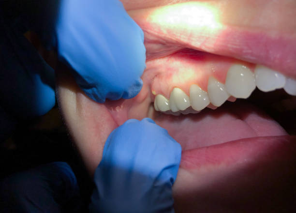 Best Emergency Denture Repair in Bayou Gauche, LA